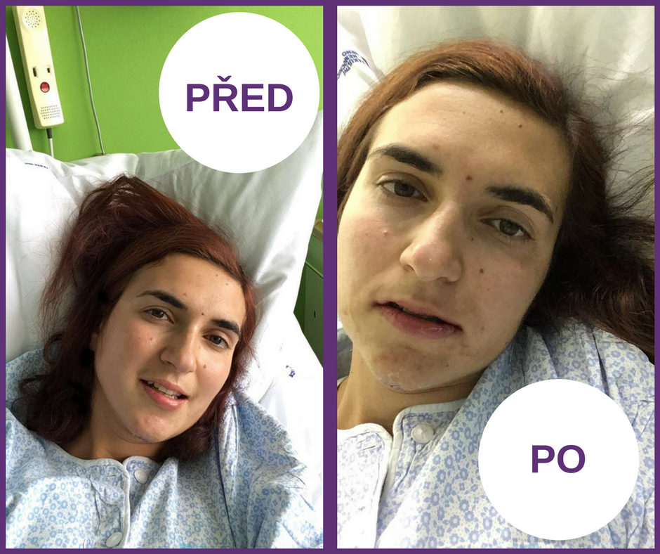 Obrázek, jak jsem vypadala před a po zdrátování čelisti